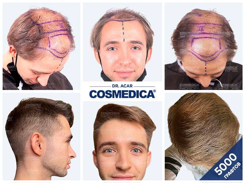 Фотоконтент является собственностью клиники Cosmedica, Турция