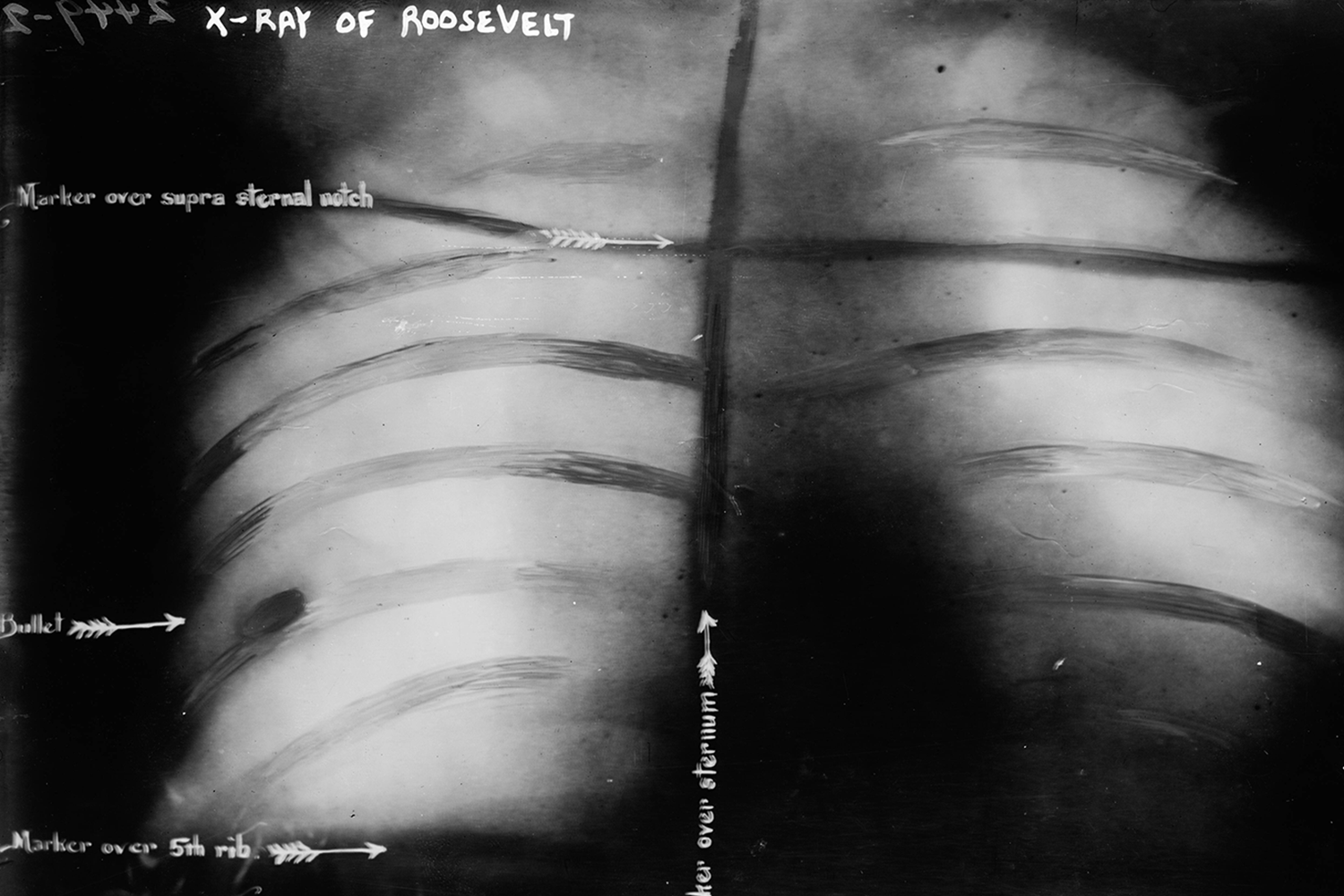 После смерти Мак-Кинли выборы выиграл Теодор Рузвельт. На посту 26-го президента (1901–1909) он отработал без покушений, но после завершения полномочий дважды оказался на волосок от гибели. В 1912 г. Рузвельт пытался избраться на второй срок. 14 октября он готовился произнести речь в Милуоки, когда раздался выстрел. 36-летний Джон Шранк заявил, что мстит Рузвельту по приказу призрака застреленного Мак-Кинли. Пуля пробила футляр от очков, рукопись с речью во внутреннем кармане и застряла в груди. Рузвельт решил, что, если он не кашляет кровью, то легкое не пробито, и произнес 90-минутную речь прямо с кровоточащей раной. Позже врачи решили, что извлекать пулю опасно, и он носил ее в себе до конца жизни. Выборы Рузвельт проиграл. Шранк был признан душевнобольным и умер в лечебнице через 31 год после стрельбы. Во второй раз на Рузвельта покушались во время избирательной кампании 30 мая 1916 г. Он ехал в открытой машине по Канзасу (Миссури), когда кто-то из толпы метнул в него 40-сантиметровый нож. Но промахнулся и попал в дверь машины. В пылу предвыборной кампании Рузвельт ничего не заметил.На фото: рентгеновский снимок Рузвельта с застрявшей пулей.